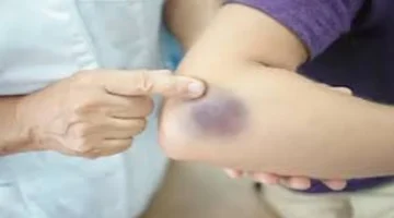 مشكلات صحية يكشفها الصداع والكدمات.. 6 علامات تحذيرية لا تتجاهلها أبداً